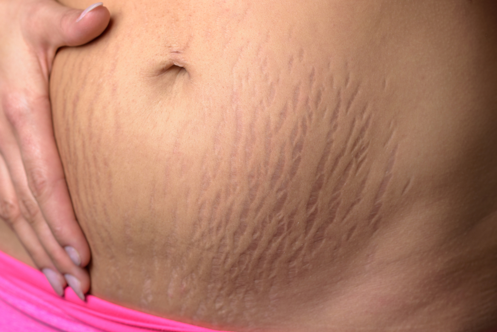 Types of Stretch Marks