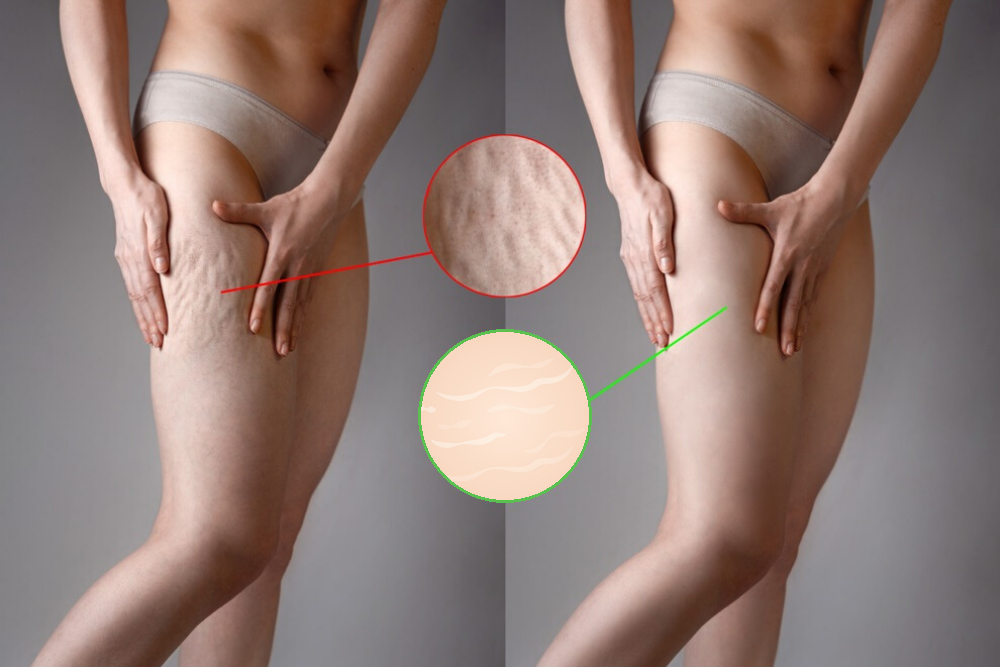 Difference Between Cellulite And Stretch Marks